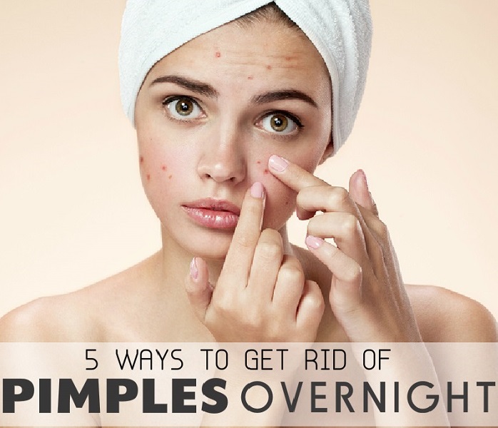 5 Home Remedies to Get Rid of Acne Overnight