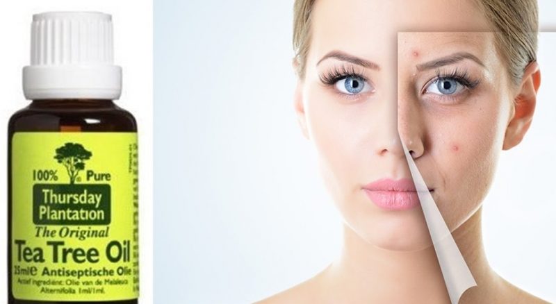 5 Home Remedies to Get Rid of Acne Overnight -1- 24beautytutorial.com